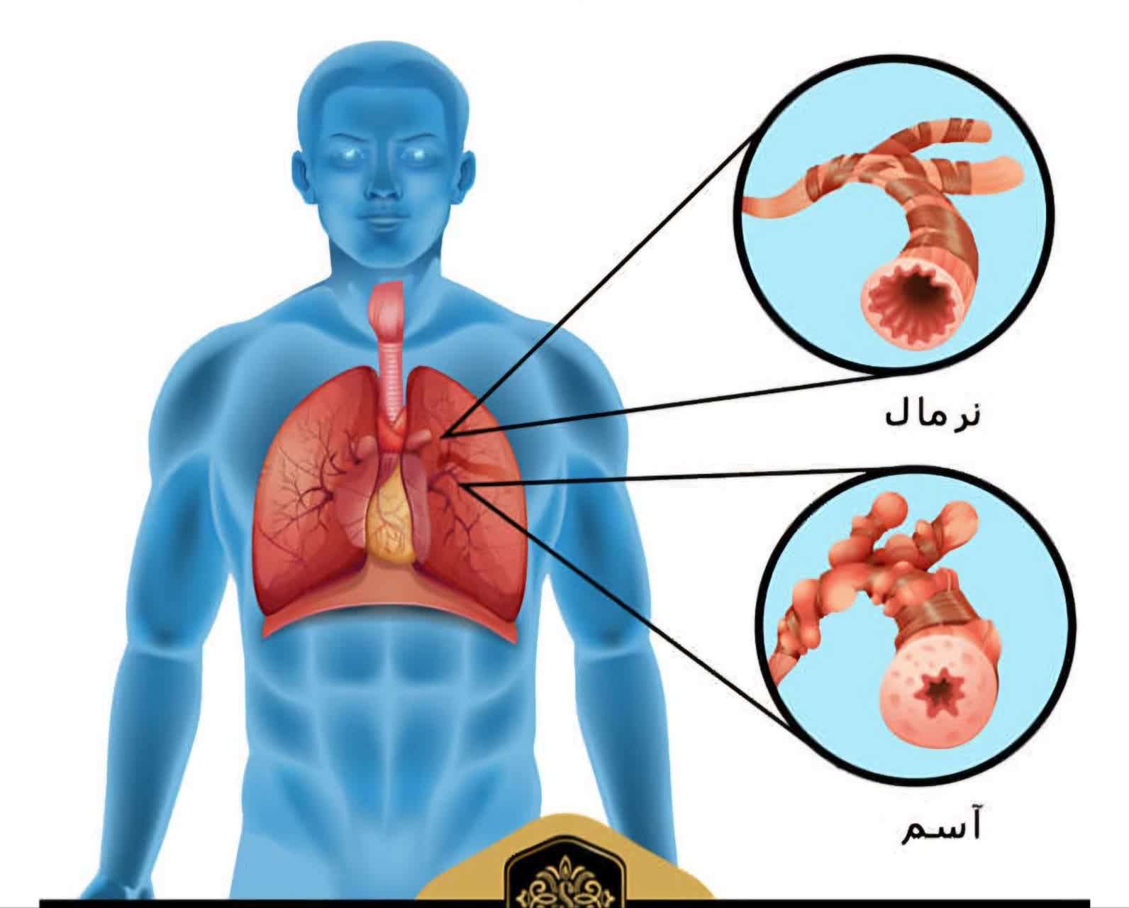 کلاس آموزشی آسم 